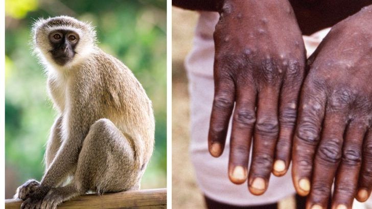 ست خرافات عن جدري القرود لا تصدقها