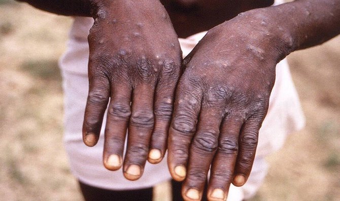 كل ما تريد معرفته عن فيروس "جدري القرود"