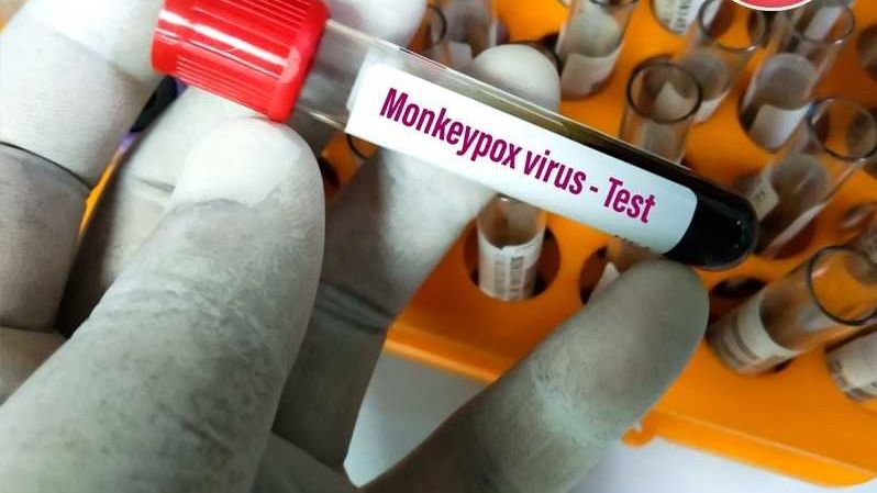 هذه نتائج تحاليل 7 حالات يشتبه في إصابتها بجدري القرود بالمغرب