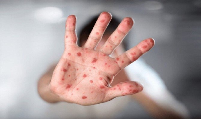 منظمة الصحة تعقد اجتماعا طارئا بسبب جدري القرود